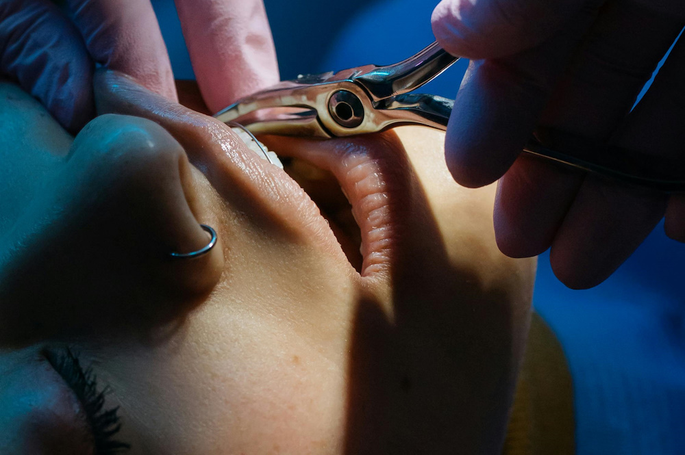 Tratamiento de conducto (endodoncia) en UltraDental Lima